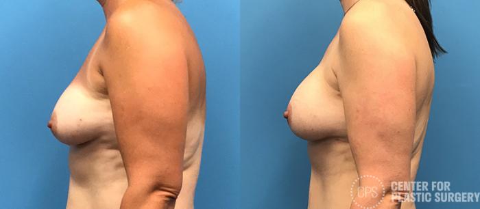 Breast Reconstruction Case 139 Before & After Left Side | Chevy Chase & Annandale, Washington D.C. Metropolitan Area | Center for Plastic Surgery