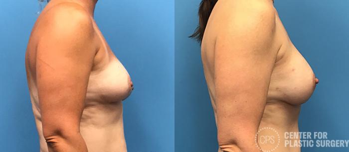 DIEP Flap Case 139 Before & After Right Side | Chevy Chase & Annandale, Washington D.C. Metropolitan Area | Center for Plastic Surgery