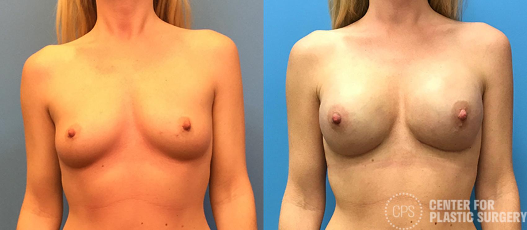 Breast Reconstruction Case 140 Before & After Front | Annandale, Washington D.C. Metropolitan Area | Center for Plastic Surgery