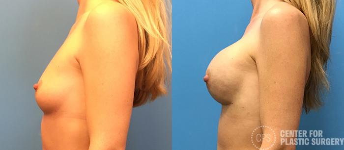 Breast Reconstruction Case 140 Before & After Left Side | Chevy Chase & Annandale, Washington D.C. Metropolitan Area | Center for Plastic Surgery