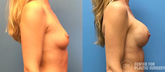 Breast Reconstruction Case 140 Before & After Right Side | Chevy Chase & Annandale, Washington D.C. Metropolitan Area | Center for Plastic Surgery