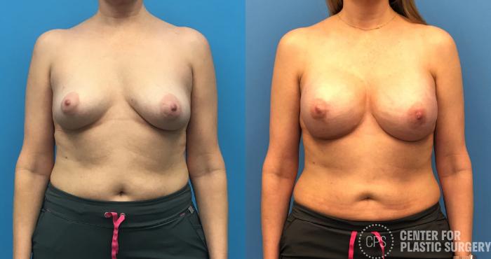 Breast Reconstruction Case 149 Before & After Front | Chevy Chase & Annandale, Washington D.C. Metropolitan Area | Center for Plastic Surgery