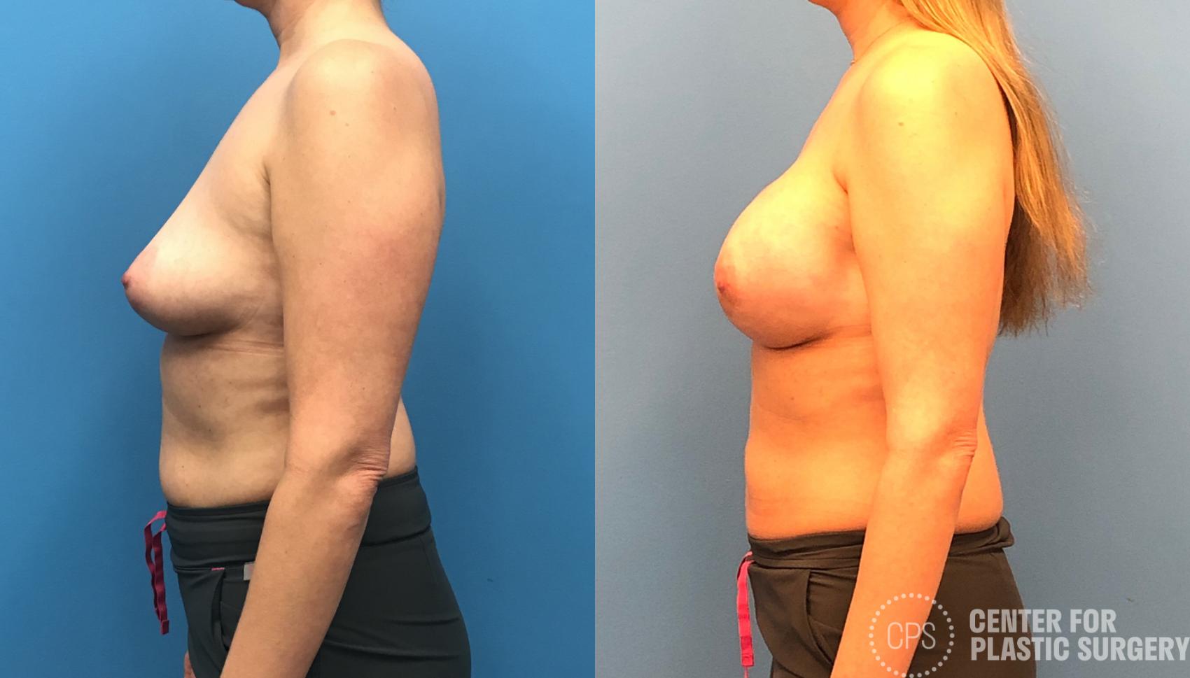 Breast Reconstruction Case 149 Before & After Left Side | Annandale, Washington D.C. Metropolitan Area | Center for Plastic Surgery