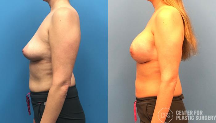 Breast Reconstruction Case 149 Before & After Left Side | Chevy Chase & Annandale, Washington D.C. Metropolitan Area | Center for Plastic Surgery
