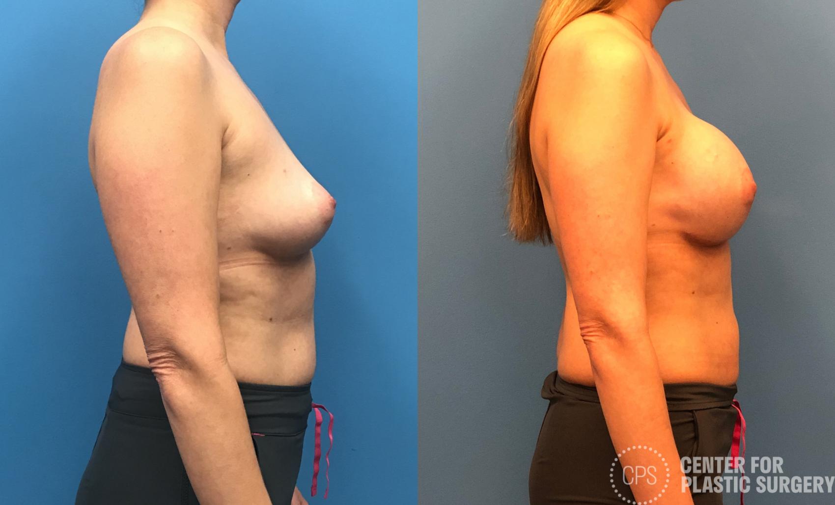 Breast Reconstruction Case 149 Before & After Right Side | Annandale, Washington D.C. Metropolitan Area | Center for Plastic Surgery