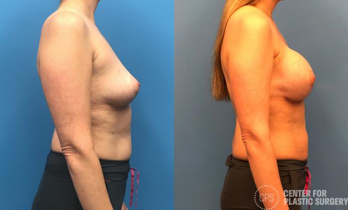 Breast Reconstruction Case 149 Before & After Right Side | Chevy Chase & Annandale, Washington D.C. Metropolitan Area | Center for Plastic Surgery