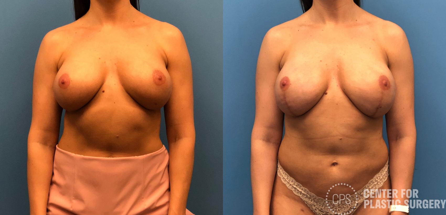 Breast Reconstruction Case 150 Before & After Front | Annandale, Washington D.C. Metropolitan Area | Center for Plastic Surgery