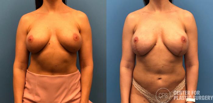 Breast Reconstruction Case 150 Before & After Front | Chevy Chase & Annandale, Washington D.C. Metropolitan Area | Center for Plastic Surgery