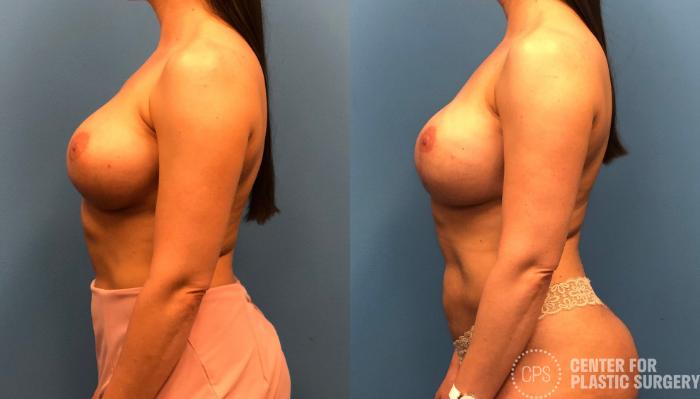 Breast Reconstruction Case 150 Before & After Left Side | Chevy Chase & Annandale, Washington D.C. Metropolitan Area | Center for Plastic Surgery