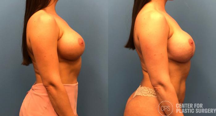 Breast Reconstruction Case 150 Before & After Right Side | Chevy Chase & Annandale, Washington D.C. Metropolitan Area | Center for Plastic Surgery
