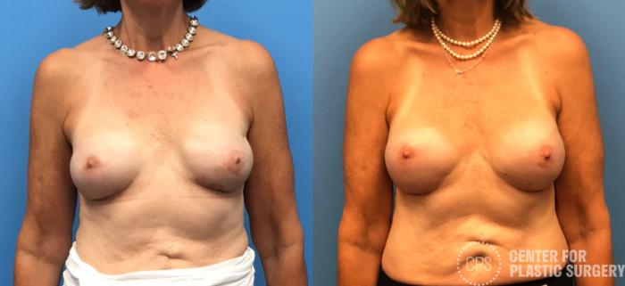 Breast Reconstruction Case 151 Before & After Front | Chevy Chase & Annandale, Washington D.C. Metropolitan Area | Center for Plastic Surgery