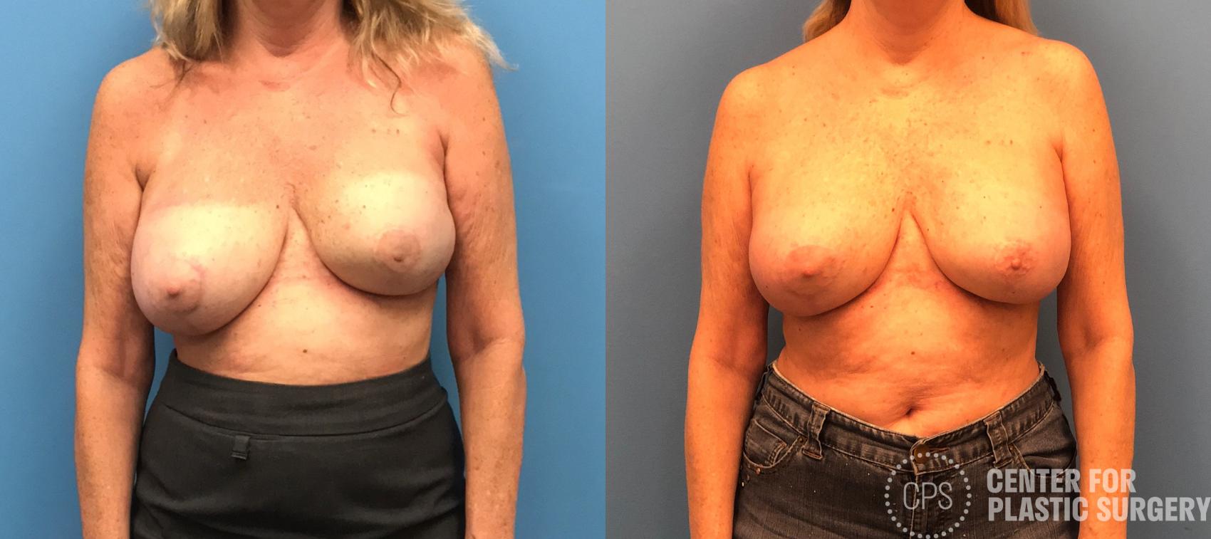 Breast Reconstruction Case 154 Before & After Front | Washington DC, Bethesda & Chevy Chase, Washington D.C. Metropolitan Area | Center for Plastic Surgery