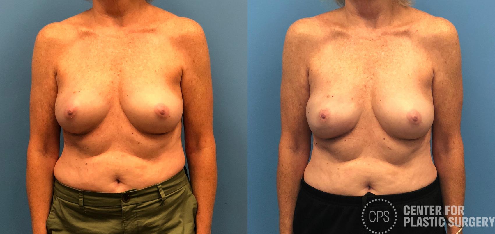 Breast Reconstruction Case 155 Before & After Front | Annandale, Washington D.C. Metropolitan Area | Center for Plastic Surgery