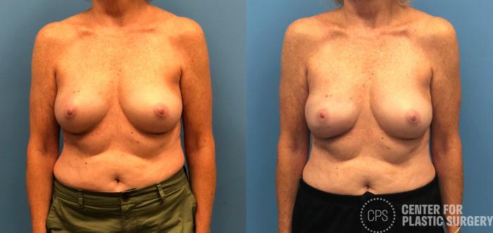 Breast Reconstruction Case 155 Before & After Front | Chevy Chase & Annandale, Washington D.C. Metropolitan Area | Center for Plastic Surgery