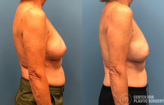 Breast Reconstruction Case 155 Before & After Right Side | Chevy Chase & Annandale, Washington D.C. Metropolitan Area | Center for Plastic Surgery