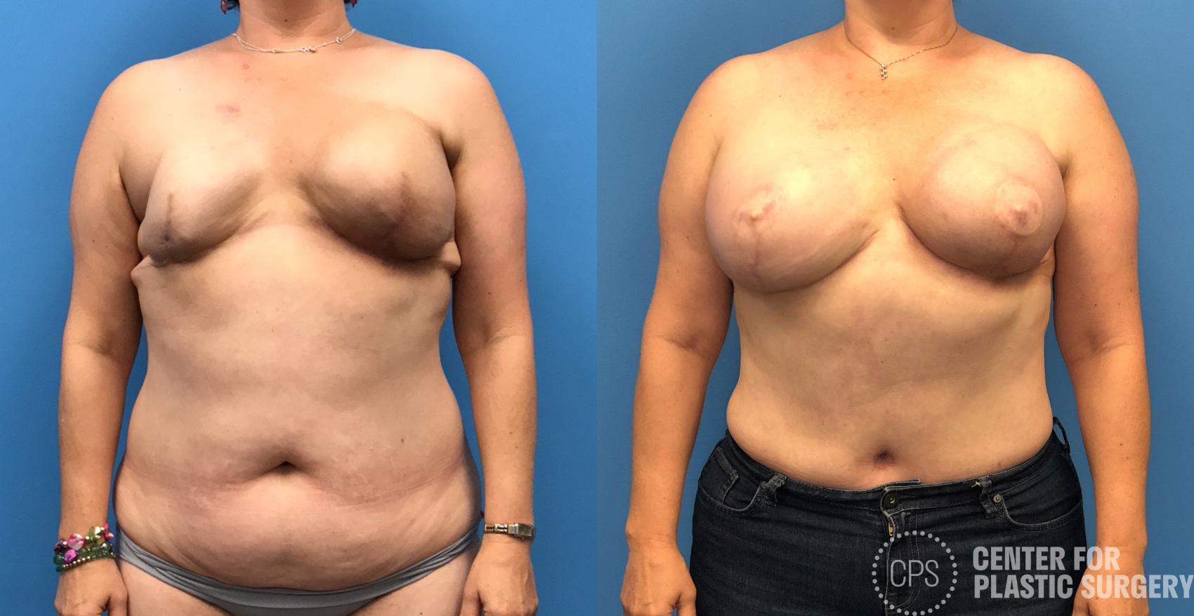 Breast Reconstruction Case 157 Before & After Front | Annandale, Washington D.C. Metropolitan Area | Center for Plastic Surgery