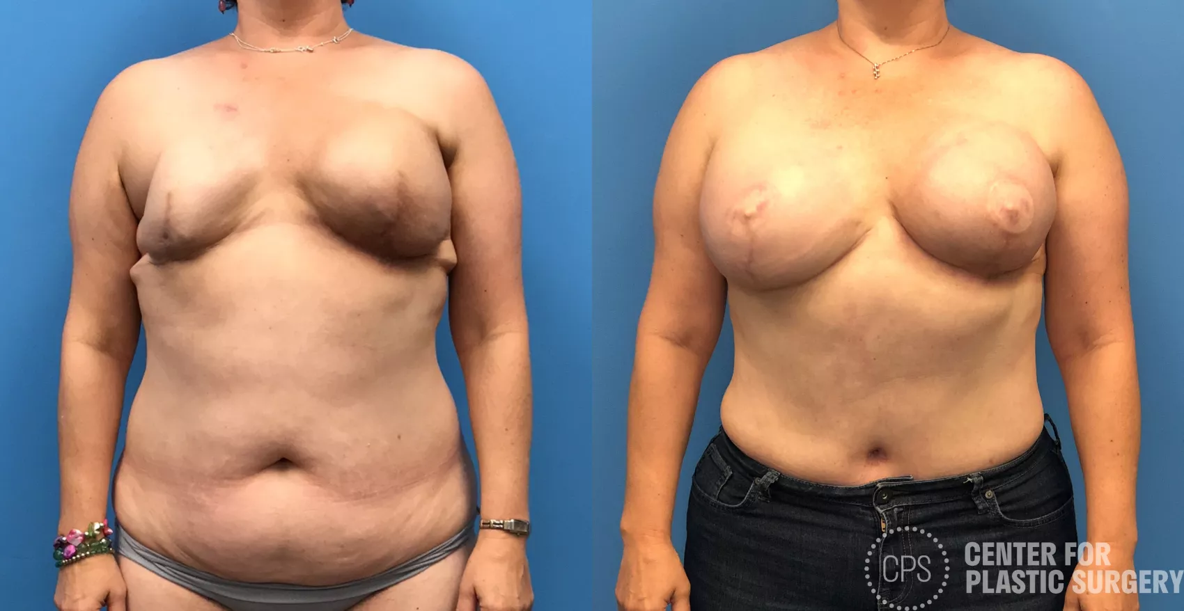 Breast Reconstruction DIEP Flap Before & After Photos of Patient at The  Center for Plastic Surgery in Washington, DC