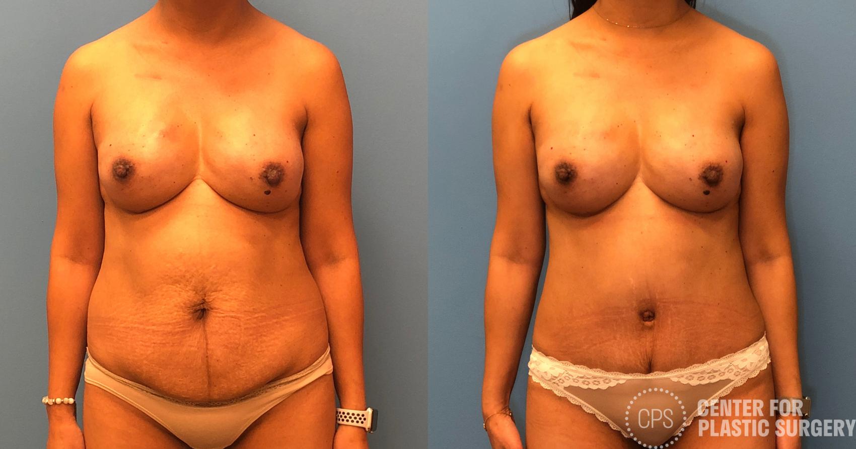 Breast Reconstruction Case 168 Before & After Front | Chevy Chase & Annandale, Washington D.C. Metropolitan Area | Center for Plastic Surgery