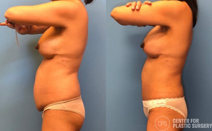 Tummy Tuck Case 168 Before & After Left Side | Chevy Chase & Annandale, Washington D.C. Metropolitan Area | Center for Plastic Surgery