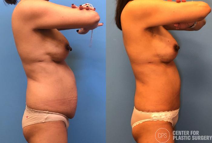 Tummy Tuck Case 168 Before & After Right Side | Chevy Chase & Annandale, Washington D.C. Metropolitan Area | Center for Plastic Surgery
