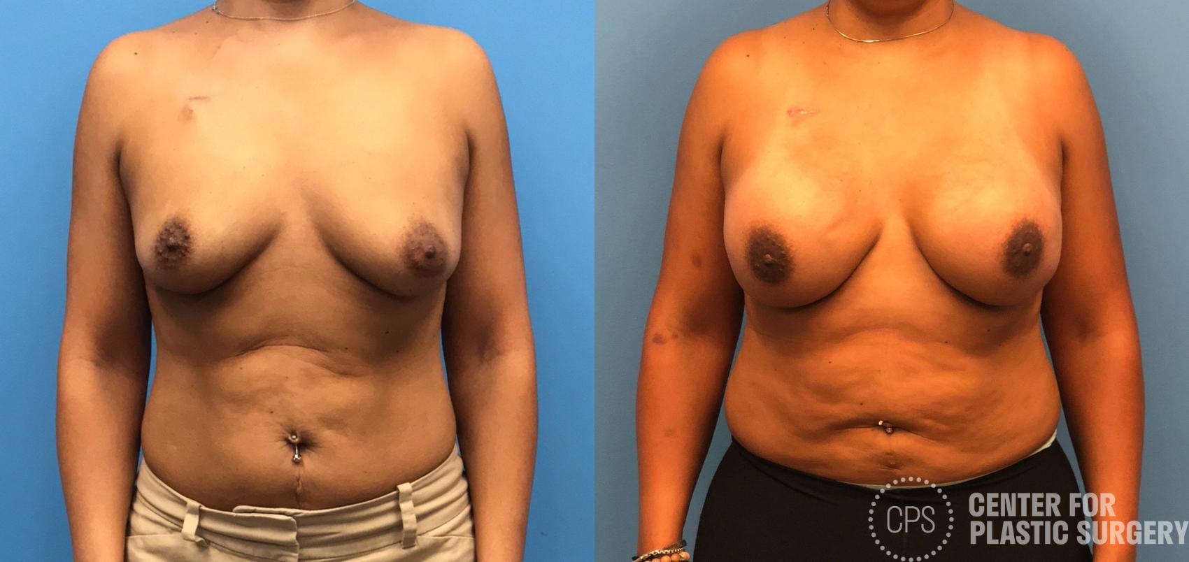Breast Reconstruction Case 173 Before & After Front | Annandale, Washington D.C. Metropolitan Area | Center for Plastic Surgery