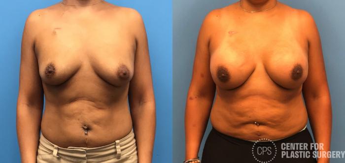 Breast Reconstruction Case 173 Before & After Front | Chevy Chase & Annandale, Washington D.C. Metropolitan Area | Center for Plastic Surgery