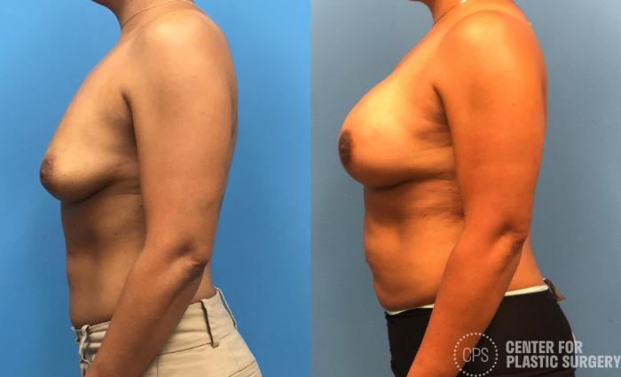 Breast Reconstruction Case 173 Before & After Left Side | Chevy Chase & Annandale, Washington D.C. Metropolitan Area | Center for Plastic Surgery
