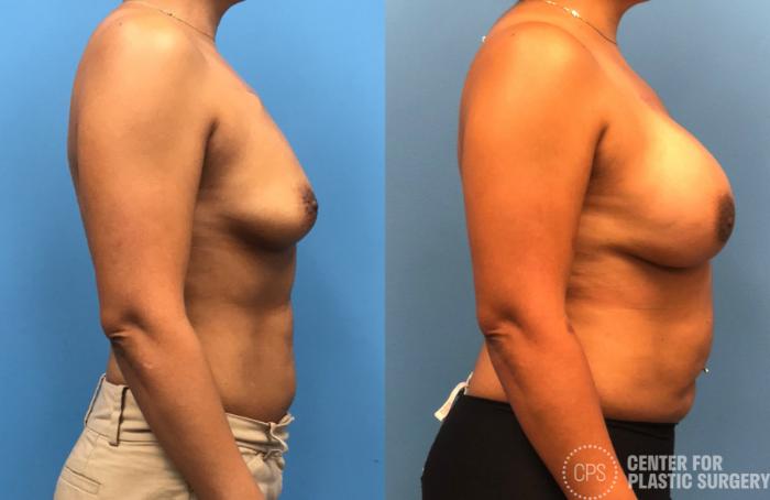 Breast Reconstruction Case 173 Before & After Right Side | Chevy Chase & Annandale, Washington D.C. Metropolitan Area | Center for Plastic Surgery