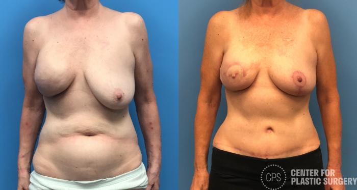 Breast Reconstruction Case 178 Before & After Front | Chevy Chase & Annandale, Washington D.C. Metropolitan Area | Center for Plastic Surgery