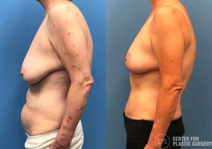 Breast Reduction Case 178 Before & After Left Side | Chevy Chase & Annandale, Washington D.C. Metropolitan Area | Center for Plastic Surgery