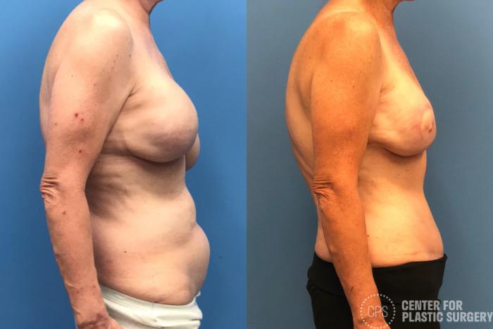 Breast Reconstruction Case 178 Before & After Right Side | Chevy Chase & Annandale, Washington D.C. Metropolitan Area | Center for Plastic Surgery