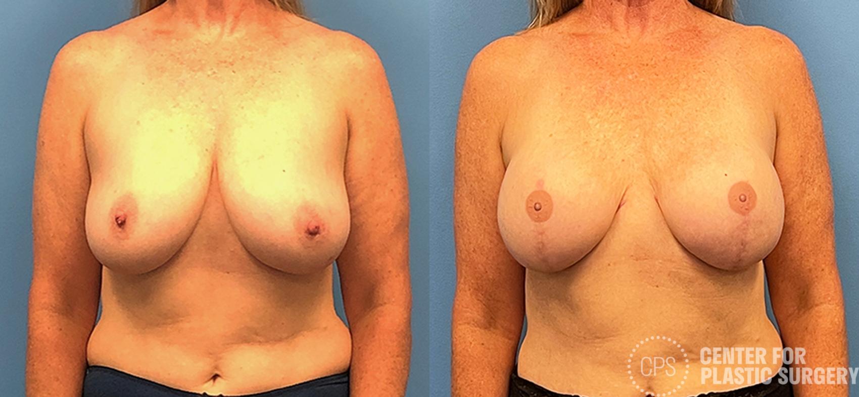 Before and After of a Breast Reconstruction and nipple reconstruction by Dr. Samir Rao. 