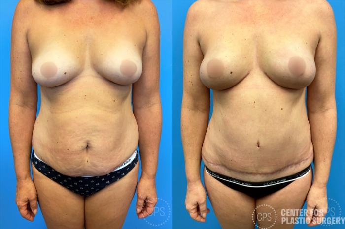 Breast Reconstruction Case 211 Before & After Front | Chevy Chase & Annandale, Washington D.C. Metropolitan Area | Center for Plastic Surgery