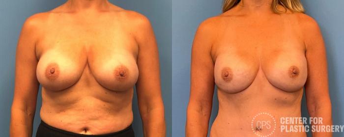 Breast Reconstruction Case 294 Before & After Front | Chevy Chase & Annandale, Washington D.C. Metropolitan Area | Center for Plastic Surgery