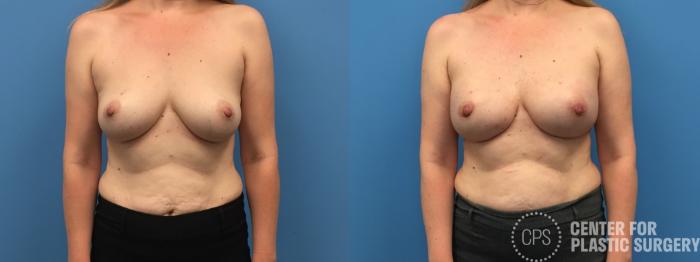 Breast Reconstruction Case 295 Before & After Front | Chevy Chase & Annandale, Washington D.C. Metropolitan Area | Center for Plastic Surgery