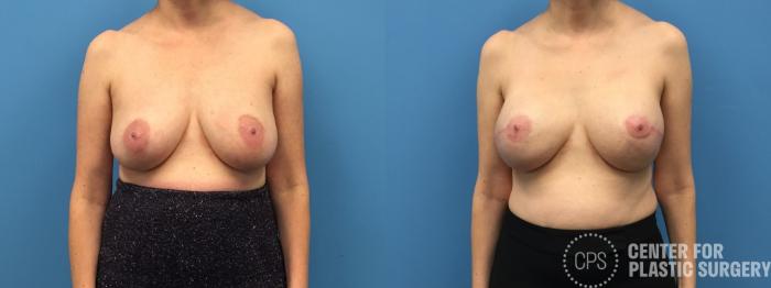 Breast Reconstruction Case 296 Before & After Front | Chevy Chase & Annandale, Washington D.C. Metropolitan Area | Center for Plastic Surgery