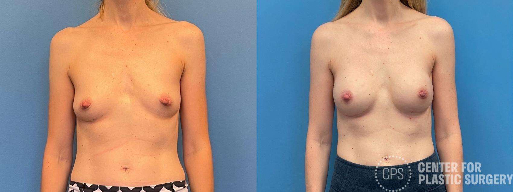 Breast Reconstruction Case 298 Before & After Front | Chevy Chase & Annandale, Washington D.C. Metropolitan Area | Center for Plastic Surgery