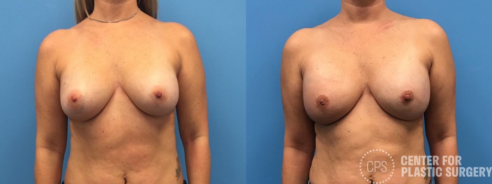 Breast Reconstruction Case 299 Before & After Front | Chevy Chase & Annandale, Washington D.C. Metropolitan Area | Center for Plastic Surgery