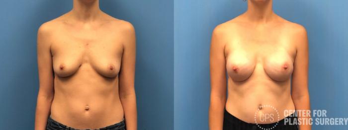 Breast Reconstruction Case 300 Before & After Front | Chevy Chase & Annandale, Washington D.C. Metropolitan Area | Center for Plastic Surgery