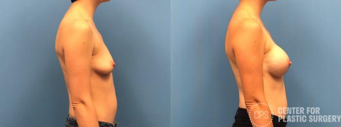 Breast Reconstruction Case 300 Before & After Right Side | Chevy Chase & Annandale, Washington D.C. Metropolitan Area | Center for Plastic Surgery