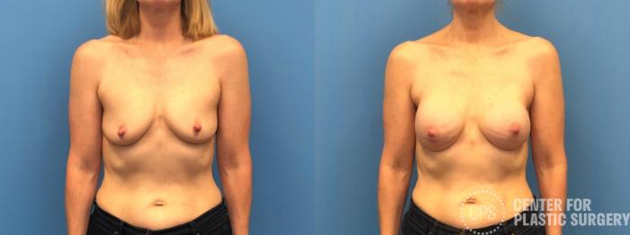 Breast Reconstruction Case 301 Before & After Front | Chevy Chase & Annandale, Washington D.C. Metropolitan Area | Center for Plastic Surgery