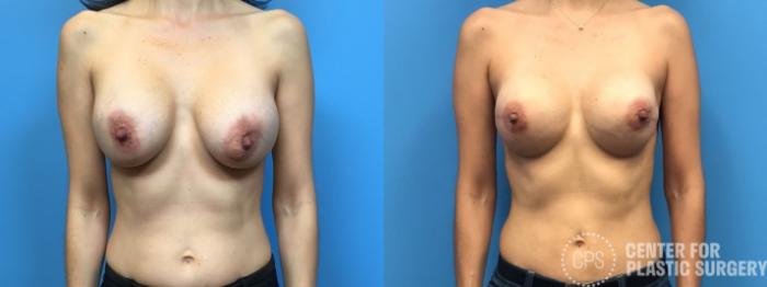 Breast Reconstruction Case 304 Before & After Front | Chevy Chase & Annandale, Washington D.C. Metropolitan Area | Center for Plastic Surgery