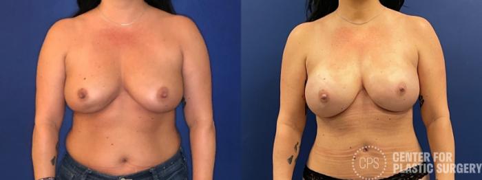 Breast Reconstruction Case 306 Before & After Front | Chevy Chase & Annandale, Washington D.C. Metropolitan Area | Center for Plastic Surgery