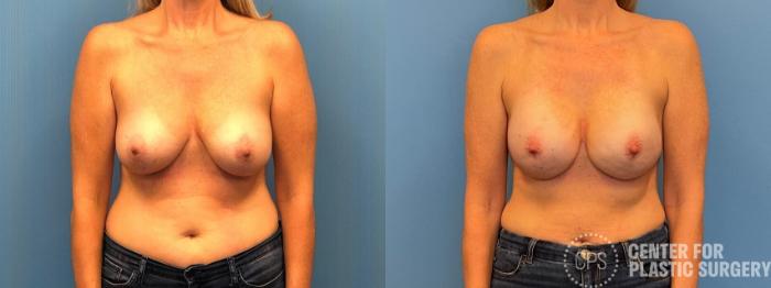 Breast Reconstruction Case 307 Before & After Front | Chevy Chase & Annandale, Washington D.C. Metropolitan Area | Center for Plastic Surgery