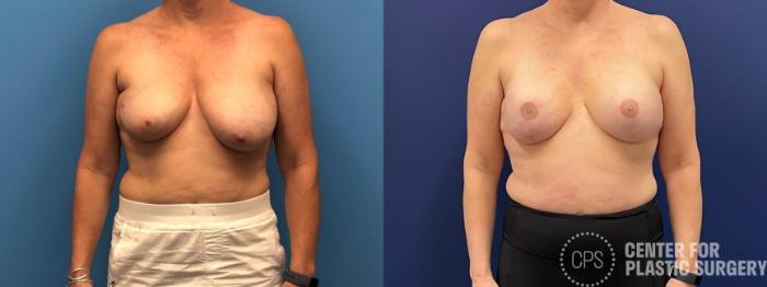 Breast Reconstruction Case 308 Before & After Front | Chevy Chase & Annandale, Washington D.C. Metropolitan Area | Center for Plastic Surgery