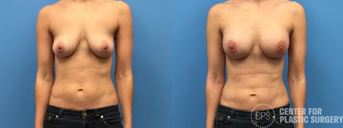 Breast Reconstruction Case 309 Before & After Front | Chevy Chase & Annandale, Washington D.C. Metropolitan Area | Center for Plastic Surgery