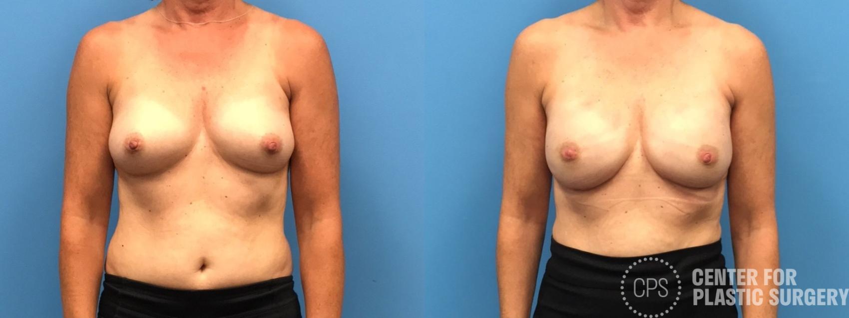 Breast Reconstruction Case 310 Before & After Front | Chevy Chase & Annandale, Washington D.C. Metropolitan Area | Center for Plastic Surgery