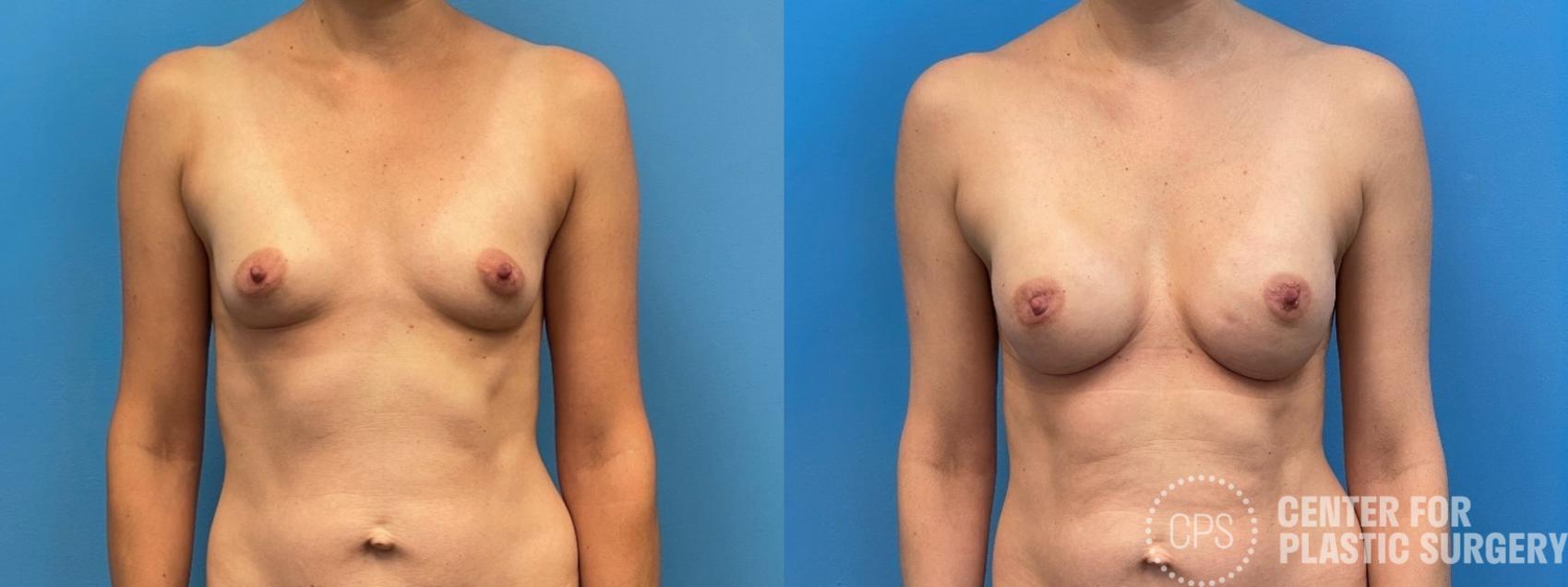 Breast Reconstruction Case 311 Before & After Front | Chevy Chase & Annandale, Washington D.C. Metropolitan Area | Center for Plastic Surgery