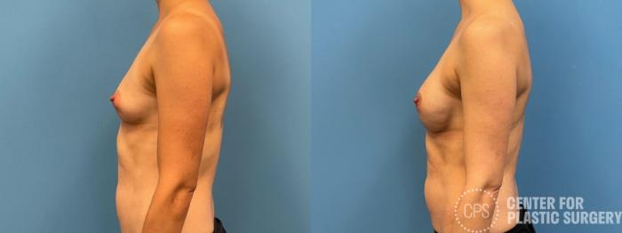 Breast Reconstruction Case 311 Before & After Left Side | Chevy Chase & Annandale, Washington D.C. Metropolitan Area | Center for Plastic Surgery