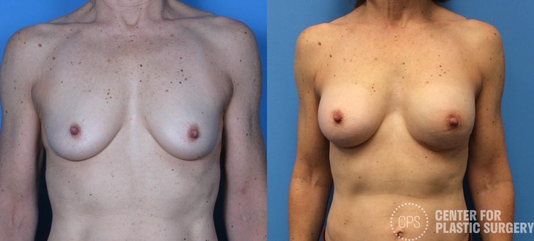 Breast Reconstruction Case 312 Before & After Front | Chevy Chase & Annandale, Washington D.C. Metropolitan Area | Center for Plastic Surgery